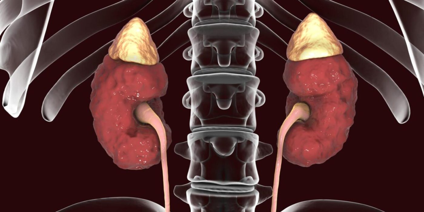 Chronic kidney disease, 3D illustration showing diseased kidney with adrenal glands, urethers and skeleton